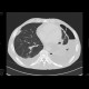 Lung cavity, pneumothorax, hydropneumothorax: CT - Computed tomography